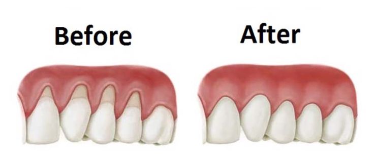 Gums tissues Regrowth