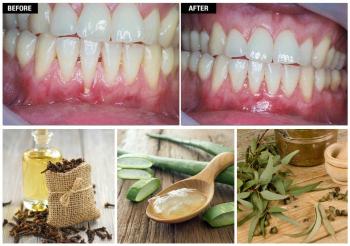 natural treatment for receding gums