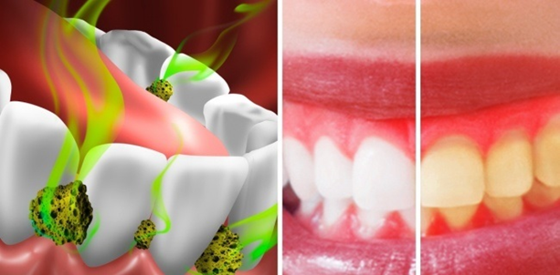 remove bacteria to improve gum health