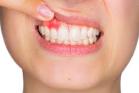 symptoms of receding gums